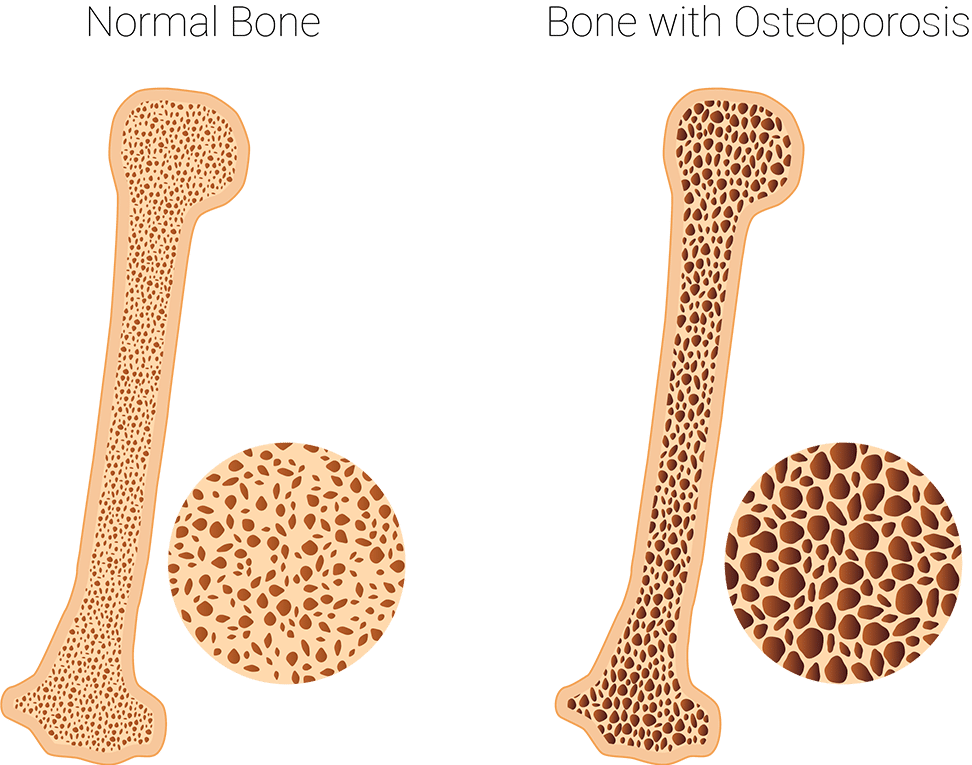 Osteoporosis bone diagram showing damage