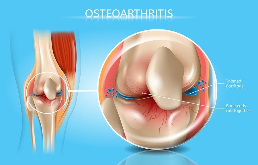 Medical infographic about osteoarthritis