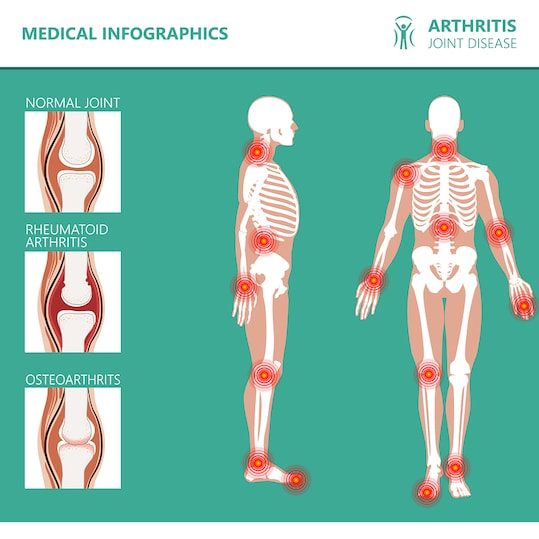 Medical infographic about forms of arthritis