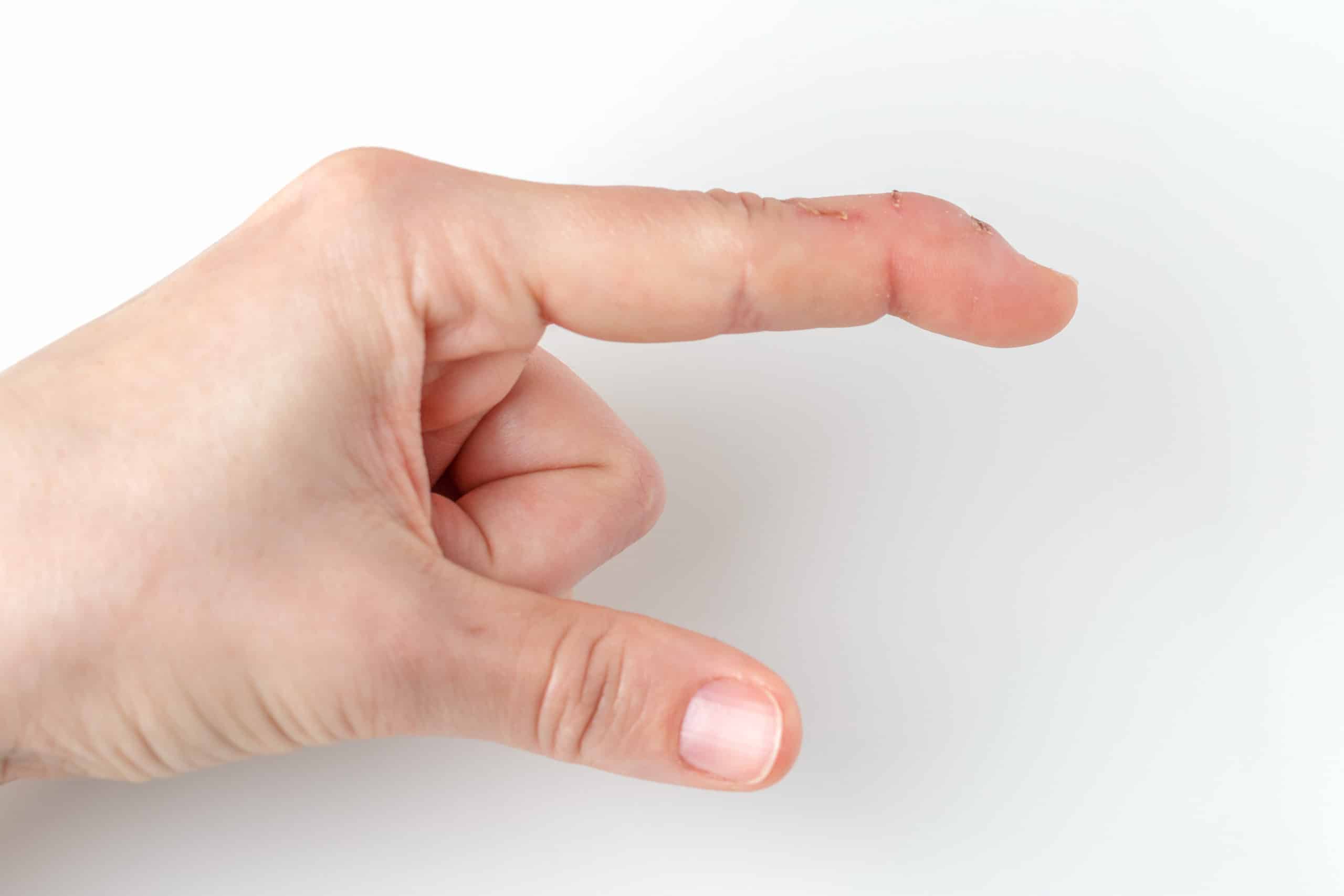 Image depicting what mallet finger looks like