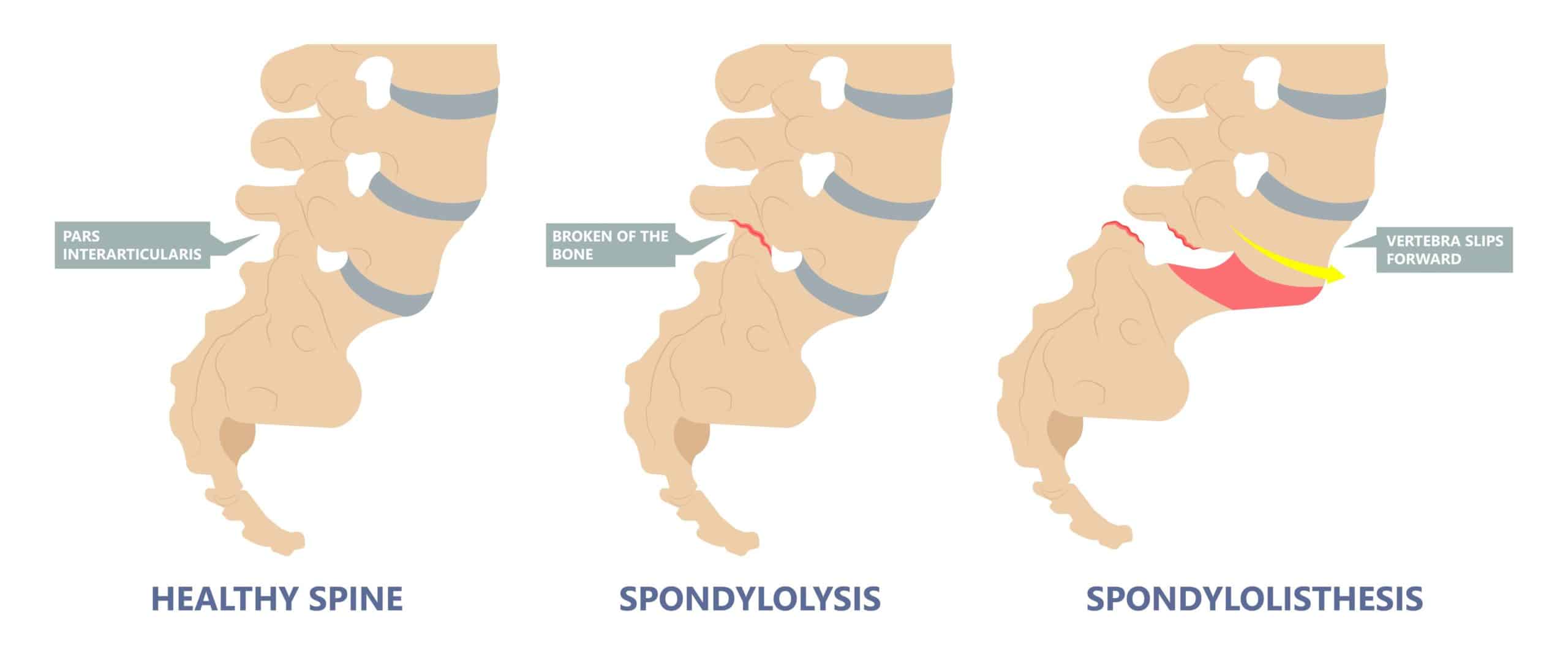Image depicting healthy spine, spondylolysis, and spondylolisthesis