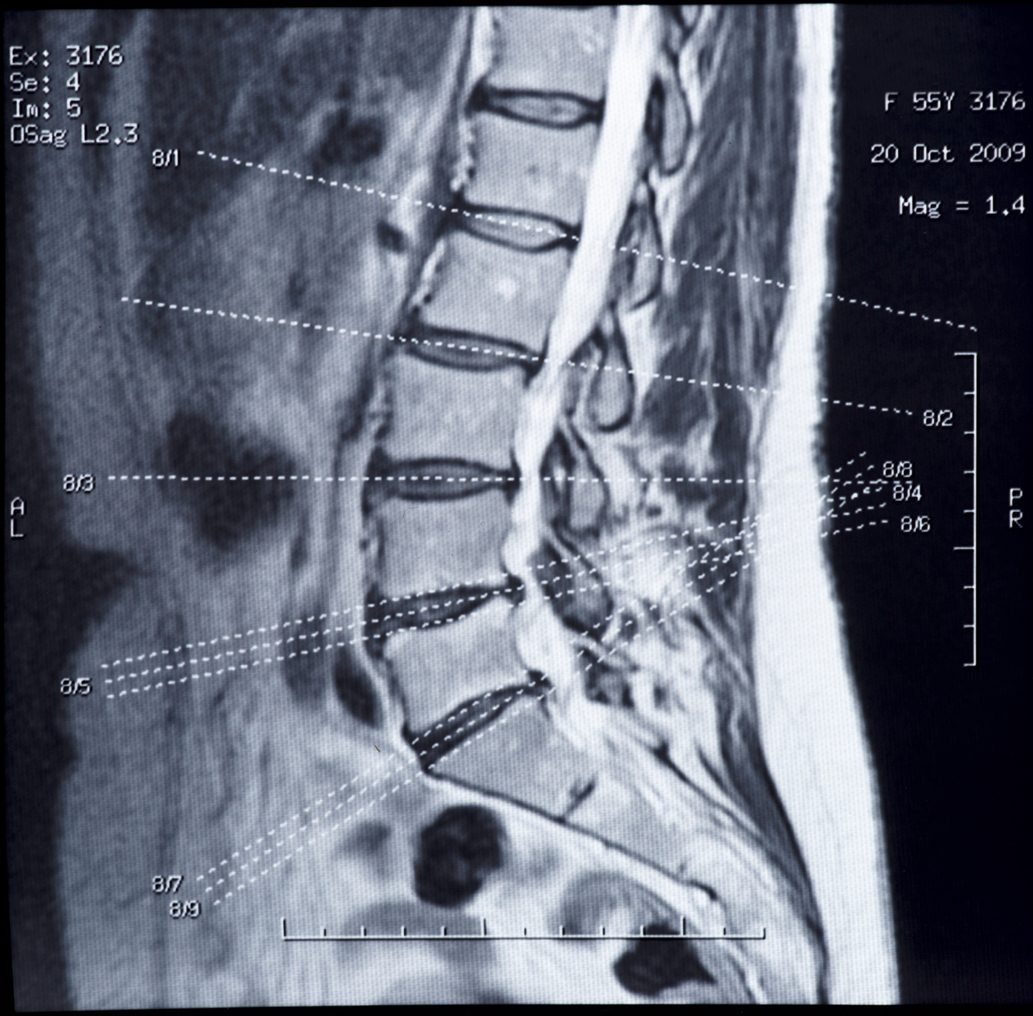 MRI of a patient’s lower back who has a herniated disc