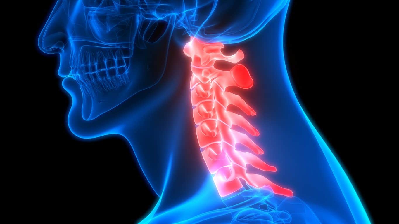 Scan of the cervical spine, indicating the need for ACDF surgery