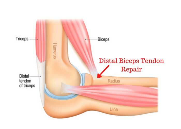 Graphic illustrating a distal biceps tendon repair in the elbow