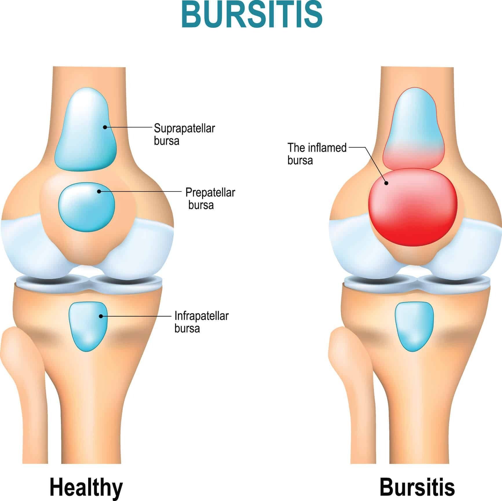Graphic illustrating a healthy knee bursa versus an inflamed bursa causing knee