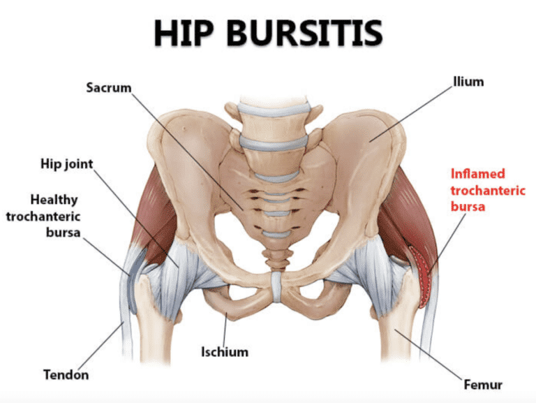Graphic illustrating an inflamed trochanteric bursa causing hip bursitis