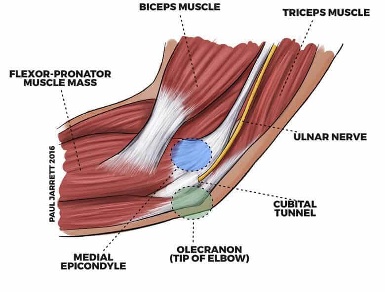 Graphic illustrating compressed elbow nerves and muscles that a cubital tunnel release surgery can alleviate