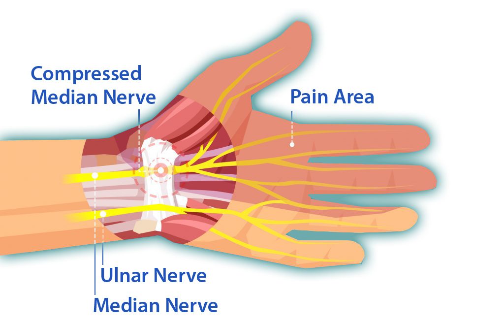 Graphic illustrating compressed wrist nerves that cause carpal tunnel syndrome and hand OT can treat