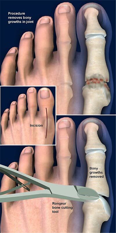 Graphic illustrating surgical procedure called Cheilectomy to remove bony growths in a big toe joint