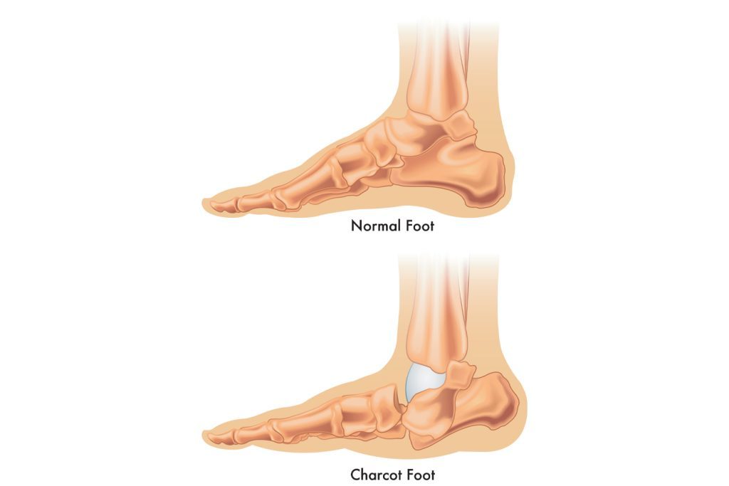 Graphic illustrating the difference between a normal foot and a charcot foot