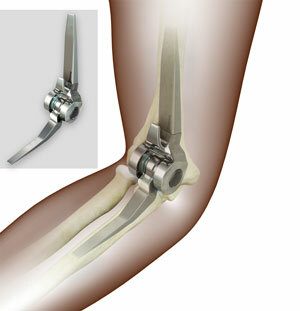 Inside an elbow illustrating the mechanism used for a total elbow arthroplasty