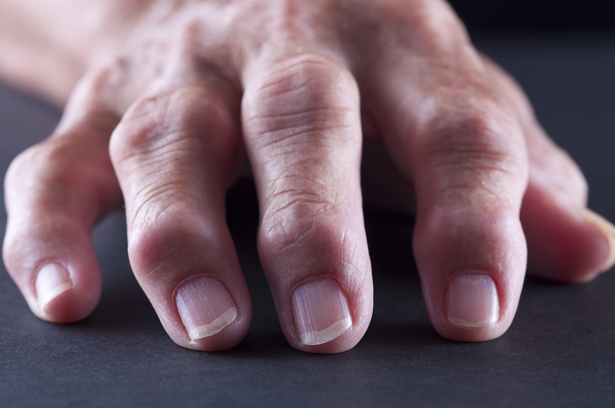 Close-up of a hand with arthritis