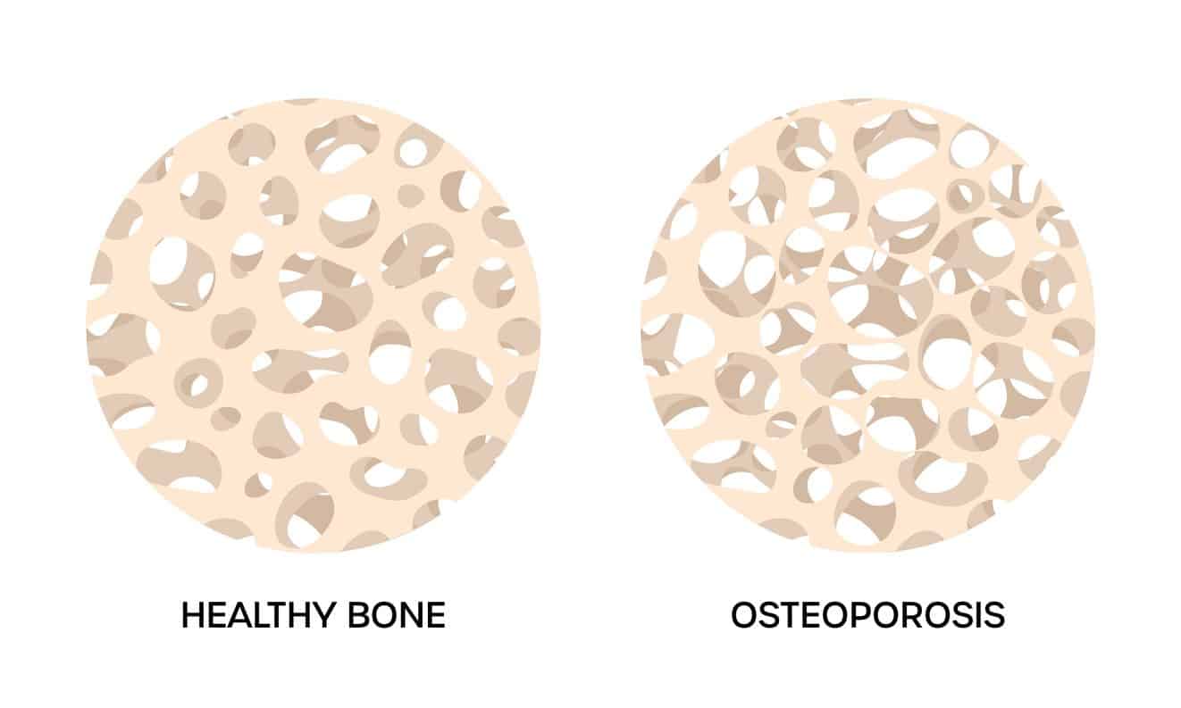 Graphic illustrating what health bone tissue looks like versus bone tissue affected by osteoporosis