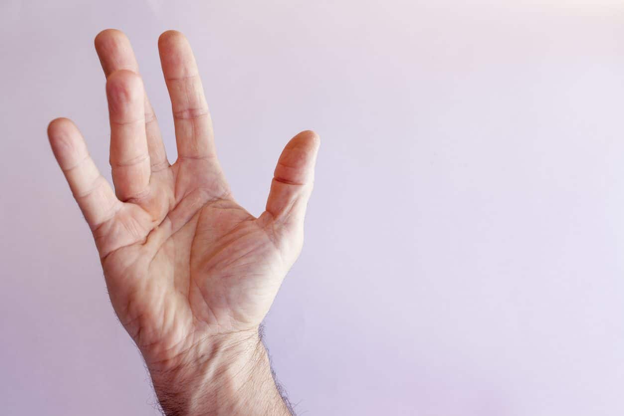 Dupuytren’s contracture hand needing OT services