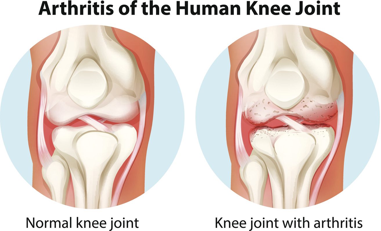 Chart showing normal knee on left side and arthritic knee on right side