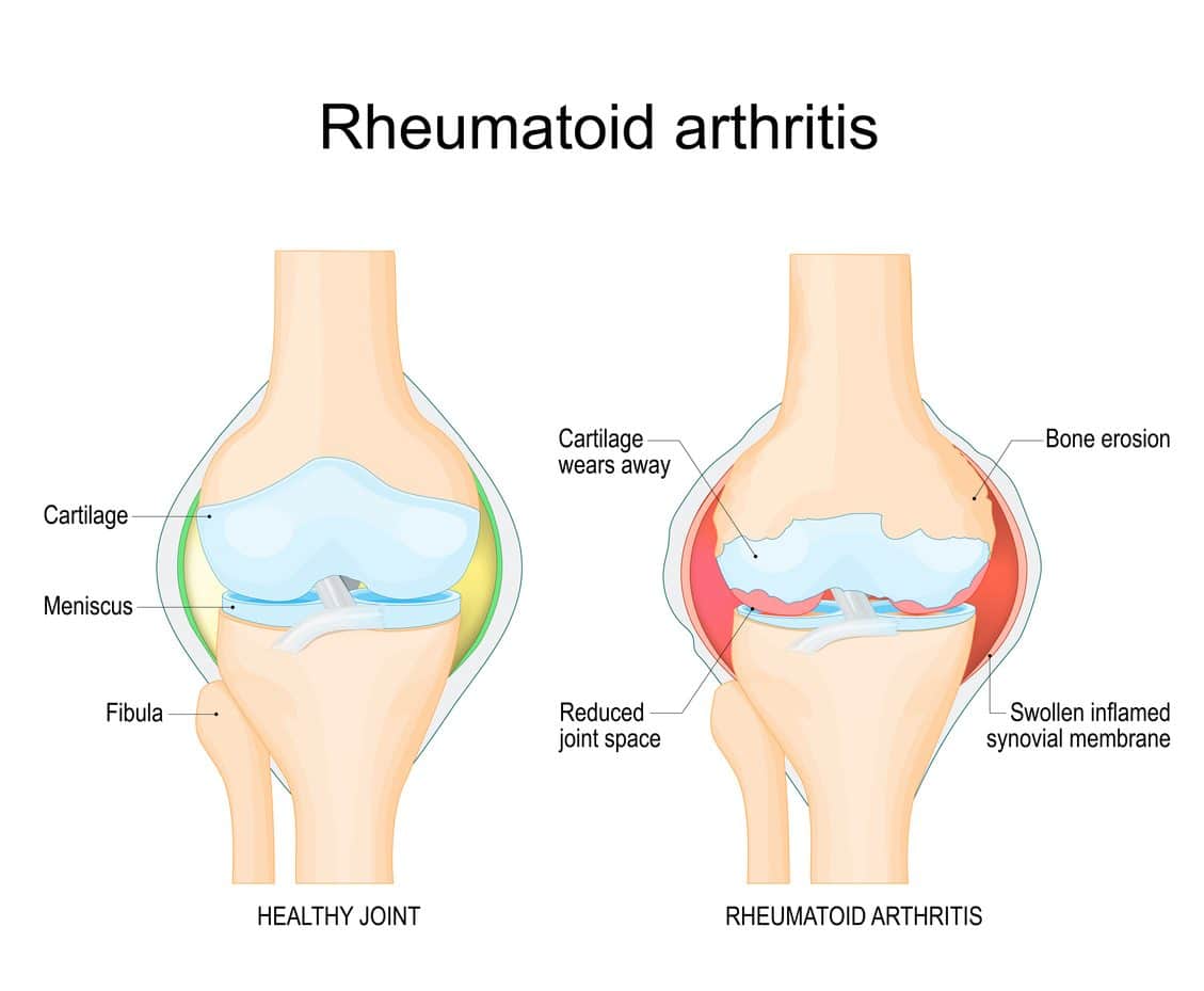 Illustration comparing normal knee on left and rheumatoid arthritis knee on right