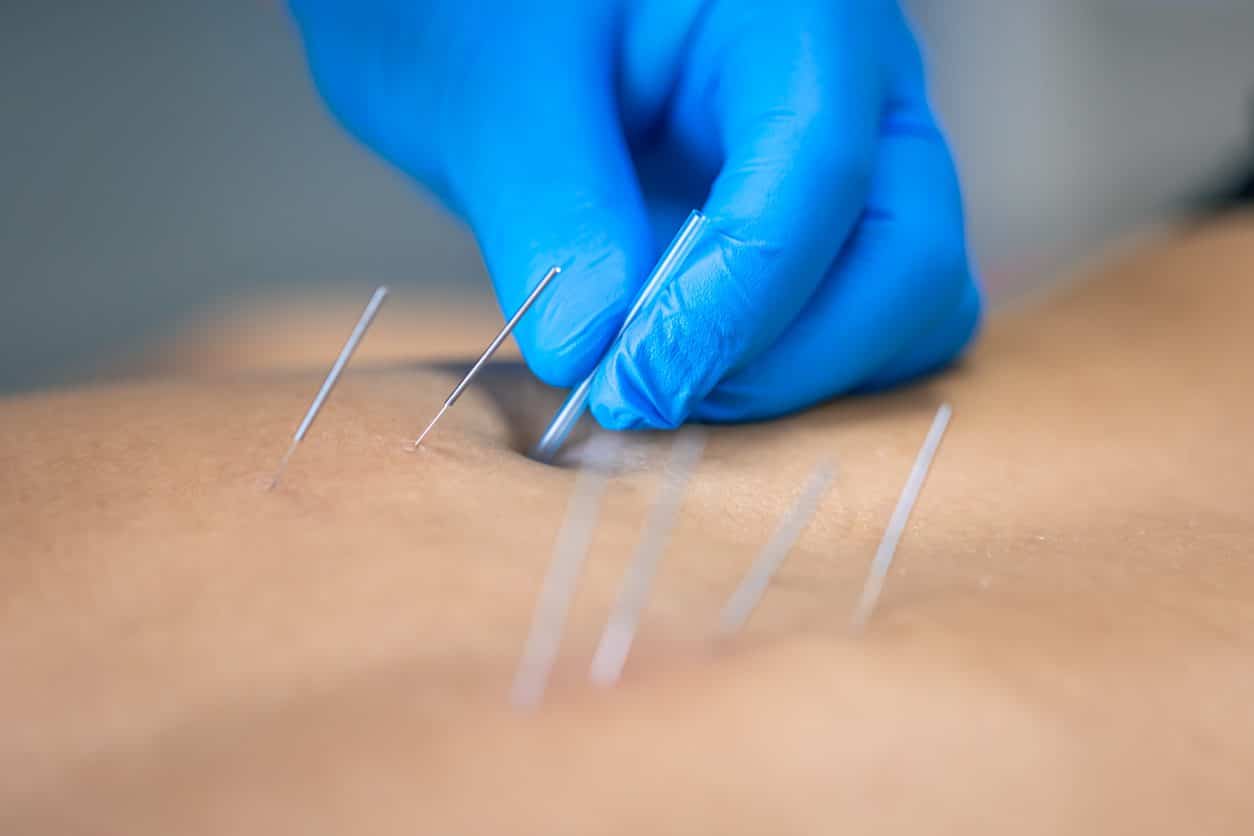 Dry needling to alleviate spine pain